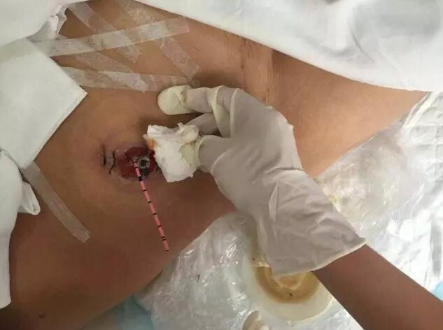 腹腔镜下膀胱全切术较开放手术优势明显,创伤小,多不需要输血,淋巴