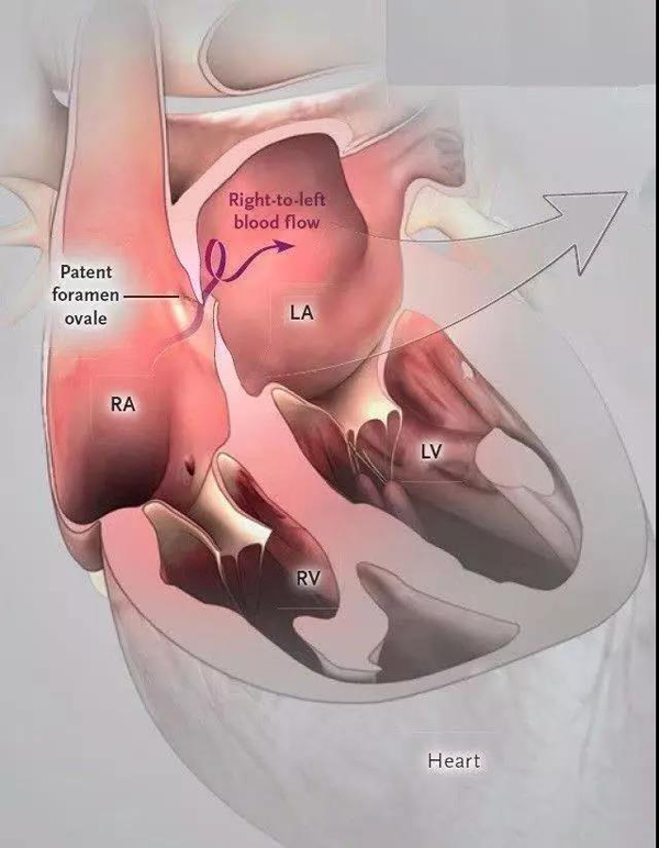 卵圆孔未闭封堵可以有效预防不明原因脑卒中复发