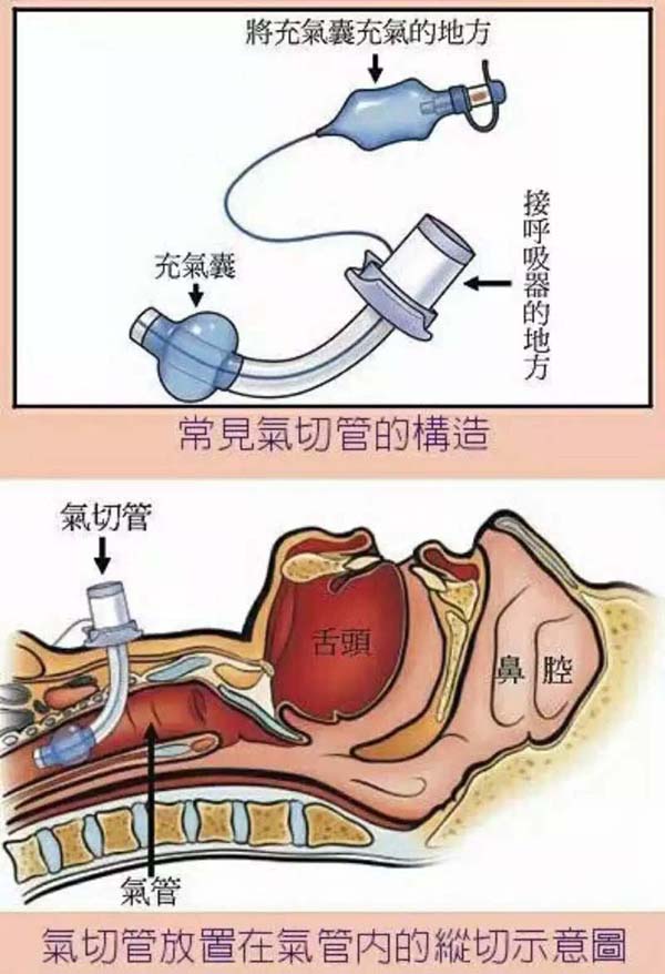 安阳市人民医院微创新领域 经皮气管切开术
